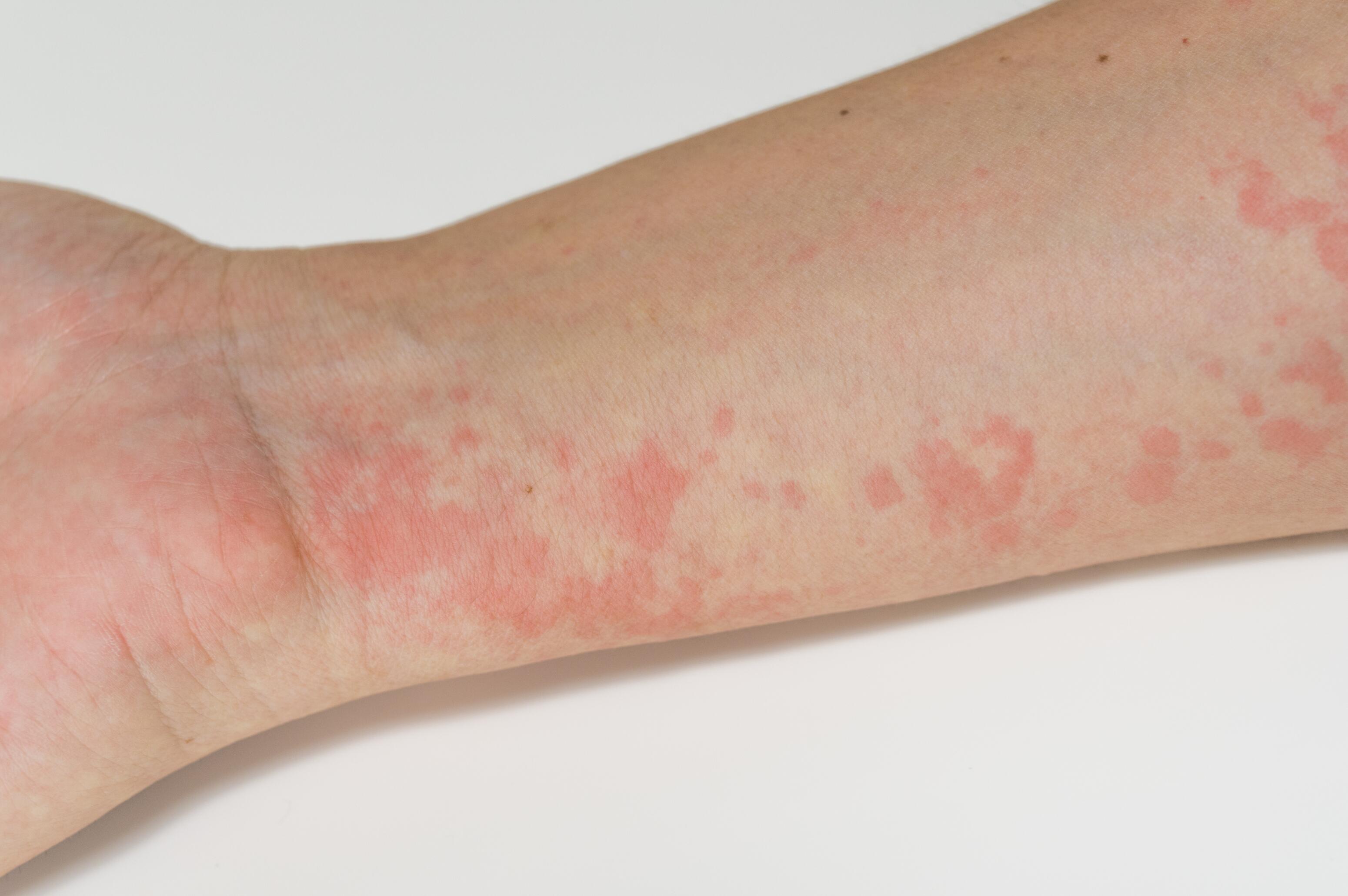 Arm with protein contact dermatitis